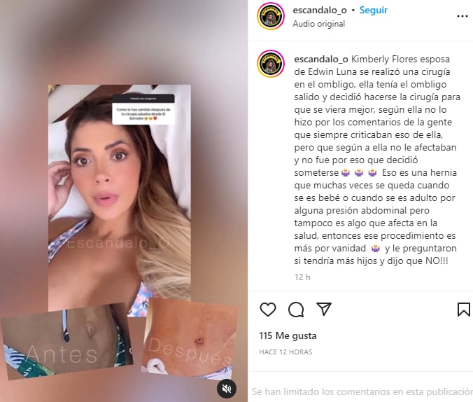 Kimberly Flores cirugía ombligo: ¿Quedó peor?