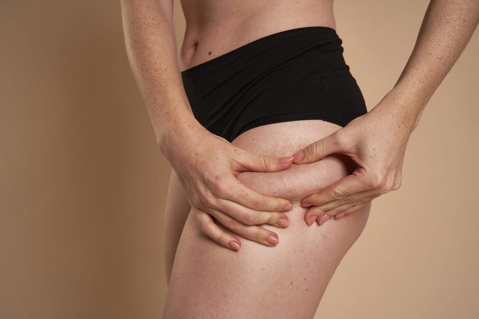 ¿Qué recomiendan los expertos para tratar la celulitis? Soluciones efectivas!
