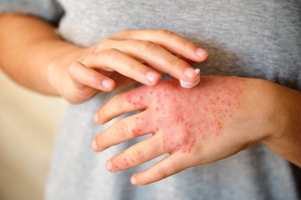 Dermatitis: Todo lo que debes saber sobre esta afección común en la piel y cómo manejarla!