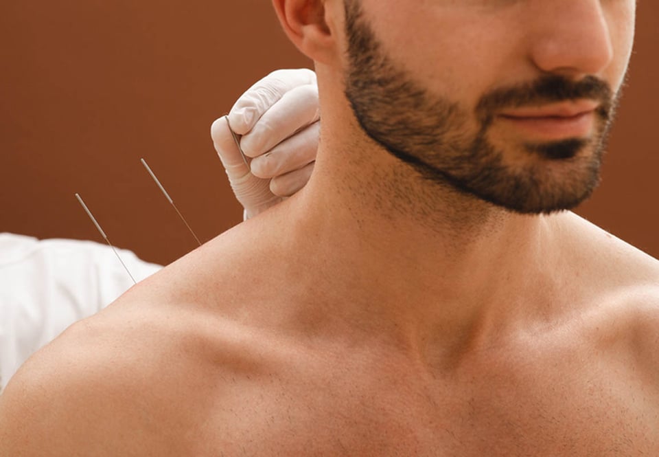 Agujas, acupuntura, hombro del hombre, medicina natural, dolor crónico.