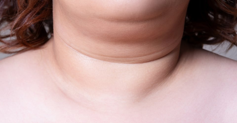 ¿Cómo puedo eliminar la papada? 5 opciones y tratamientos