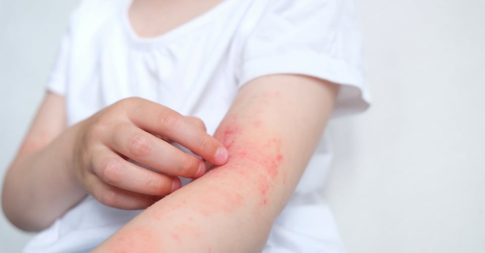 Sustancias comunes que pueden provocar alergias en los niños