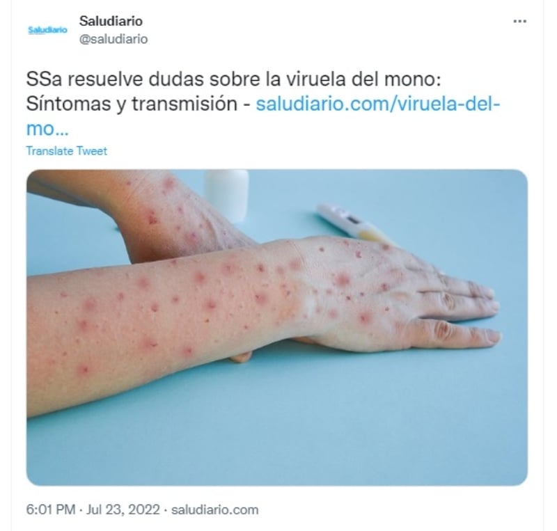 Síntomas de la viruela del mono